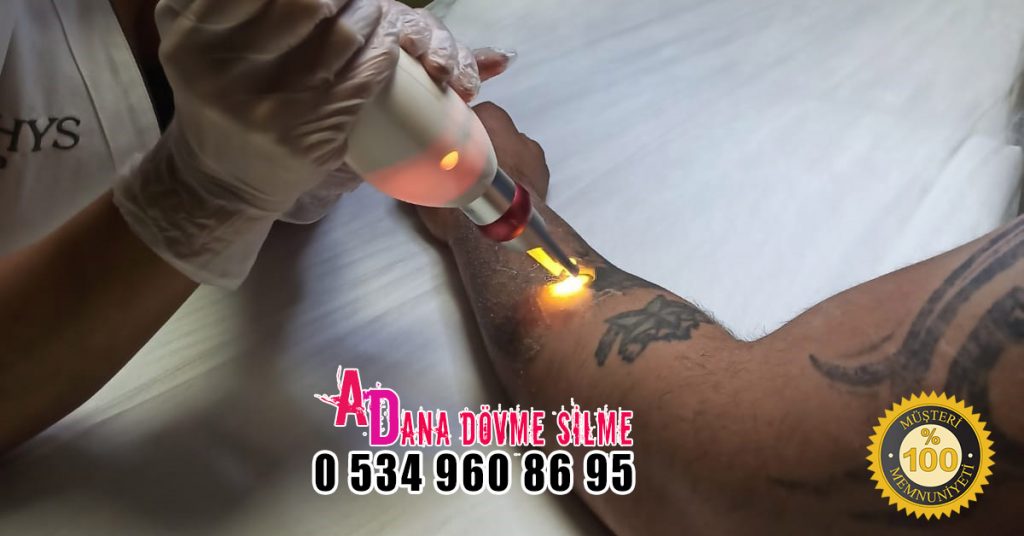 Adana Lazer Dövme Silme