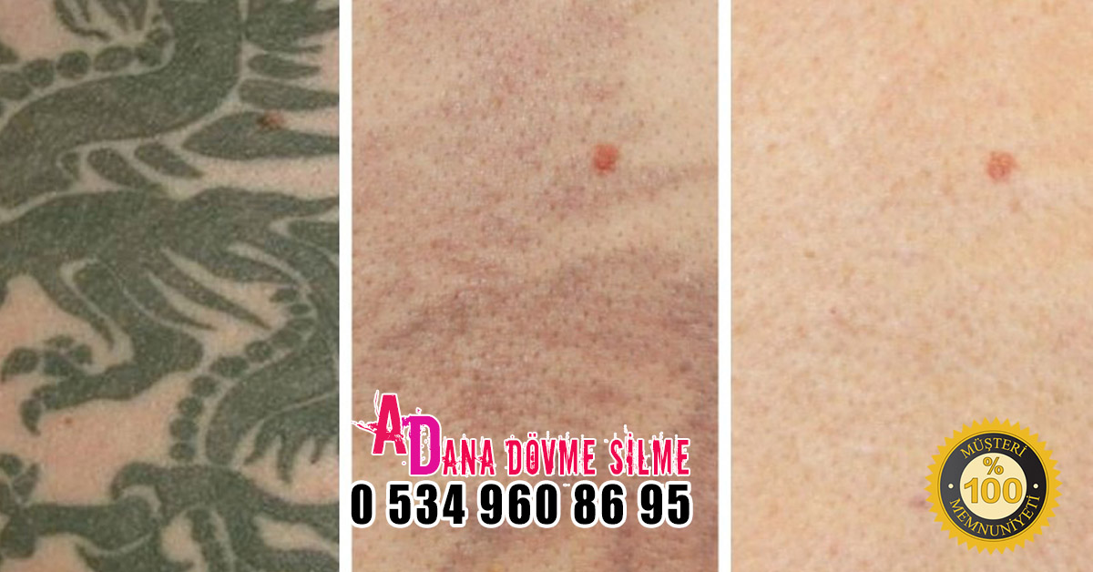 Dövme Sildirme Adana